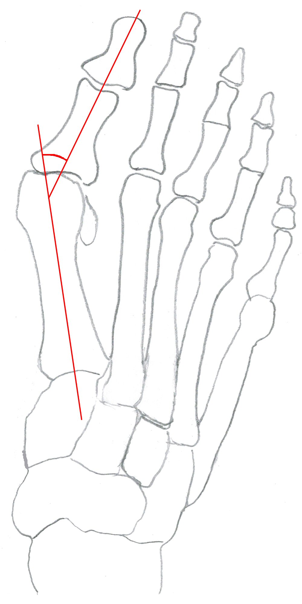 Hallux valgus-vinkel